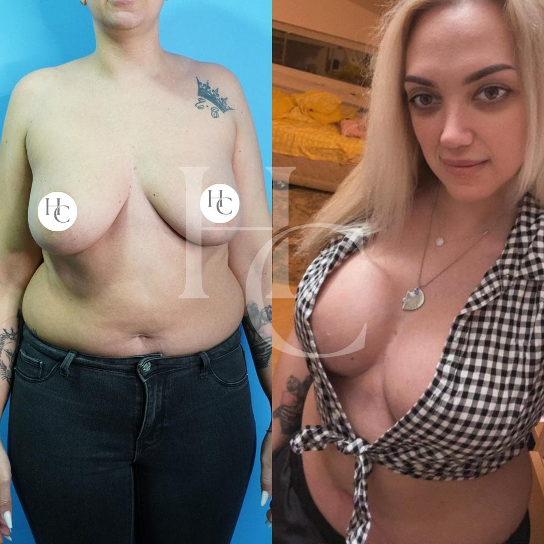 Breast Augmentation