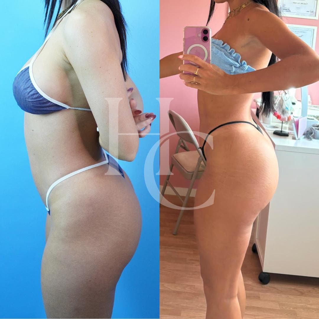 Body contouring result