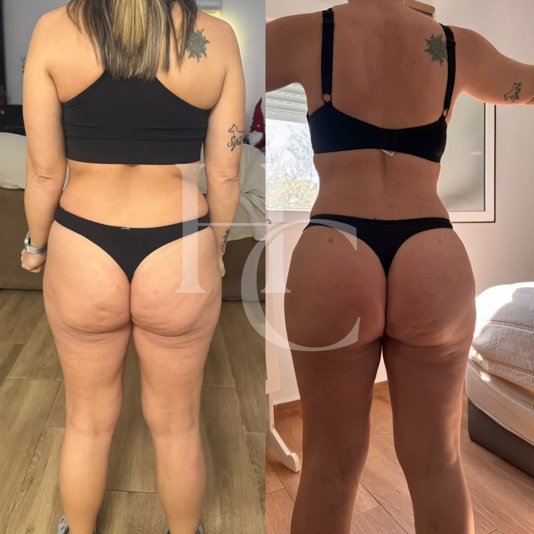 Body contouring result