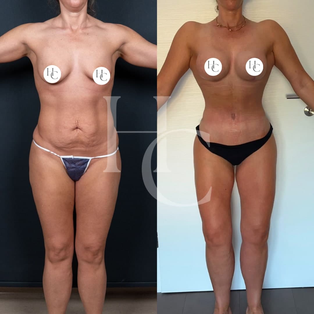 Body sculpting result