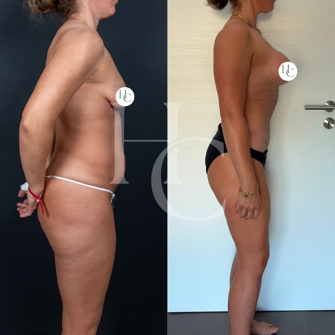 Abdominoplasty result