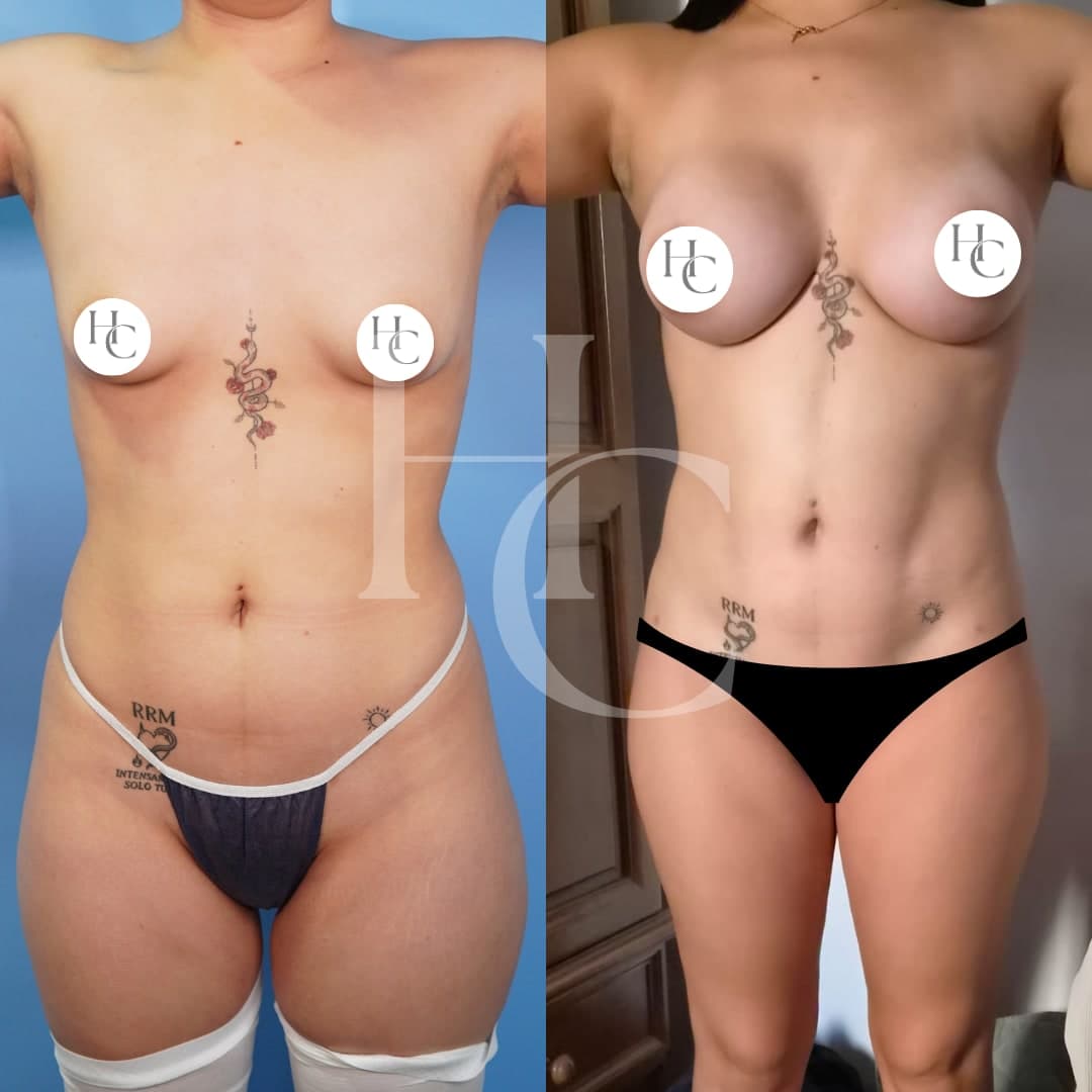 Breast surgery result