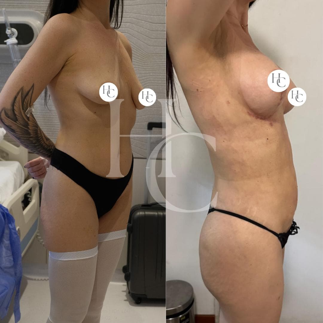 Breast surgery result