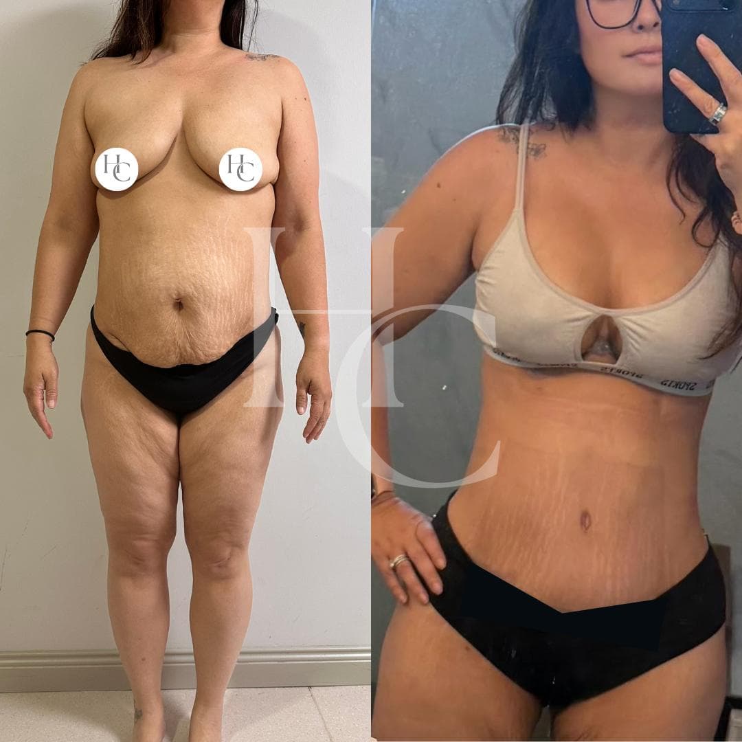 Breast surgery result
