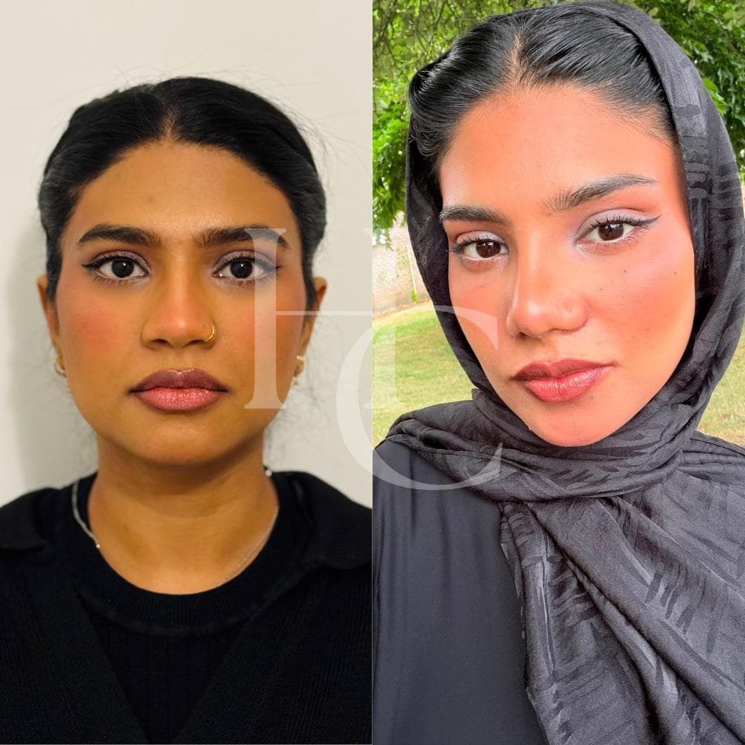 Rhinoplasty result