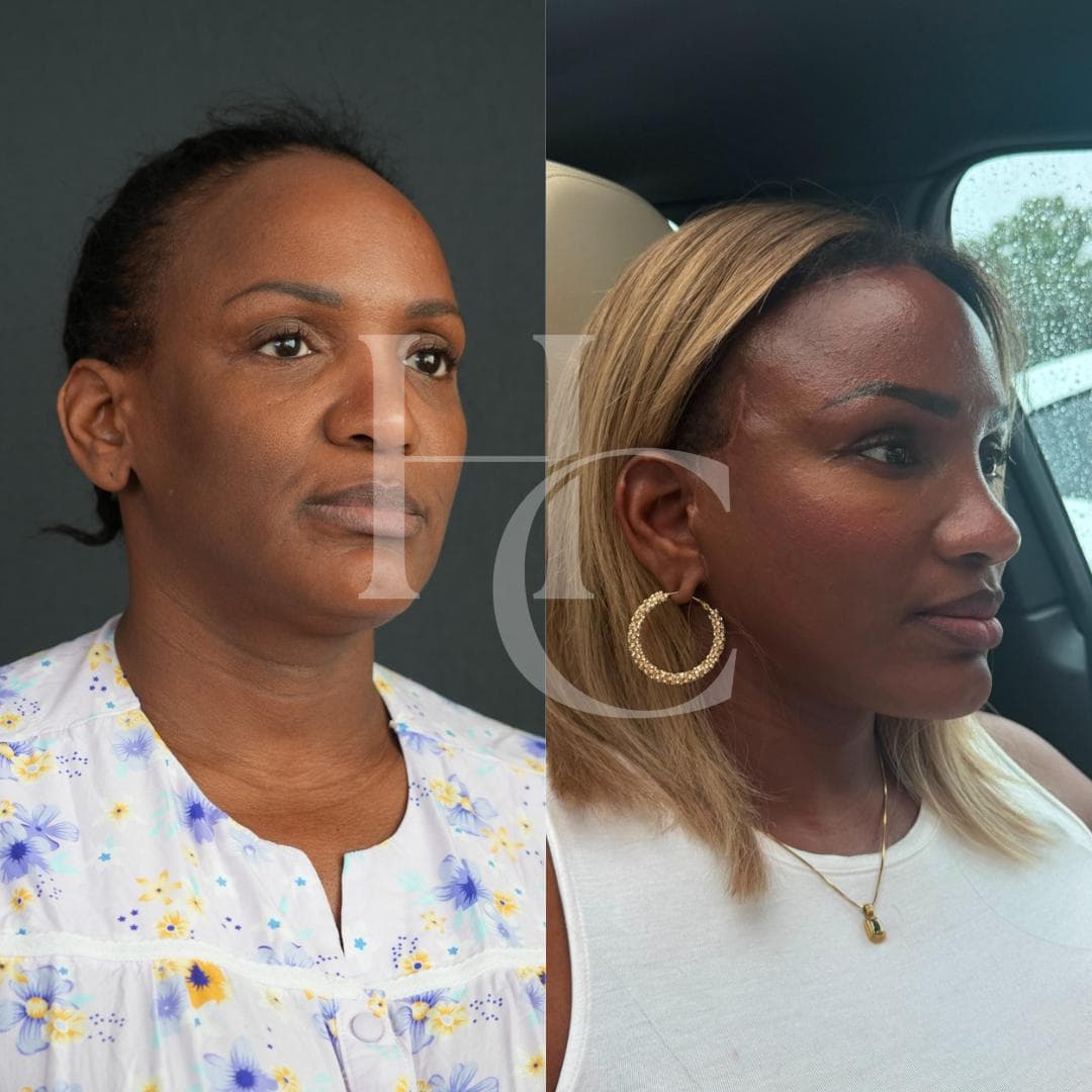 Facial surgery result